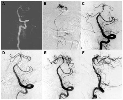 Case Report: Fenestration embedded in large vessel occlusion at non-branching site: A catastrophic trap for mechanical thrombectomy